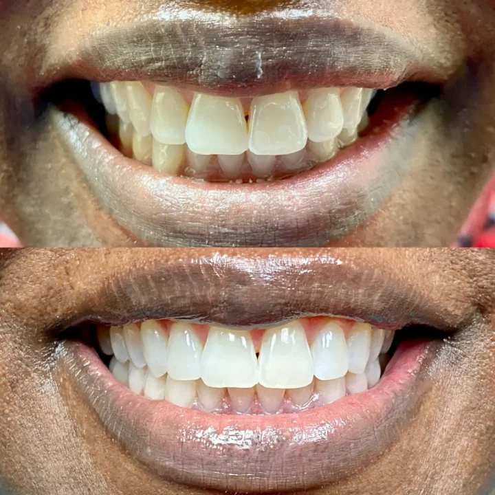 before and after of full mouth veneers