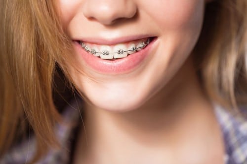 Young girl smiling, showing her braces while wearing a purple flannel