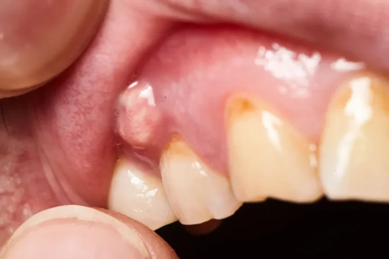 The Truth About Dental Abscesses