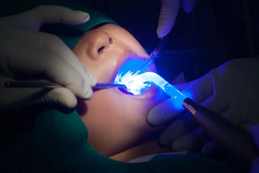Dental selants