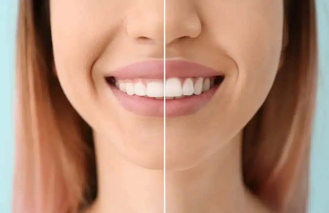 Gum contouring with a smile a spit image showing before and after