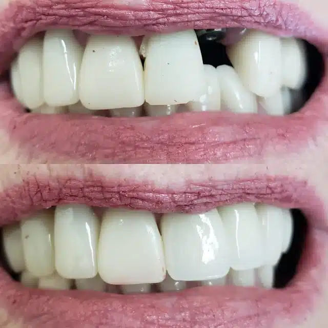 missing front tooth replaced with implant