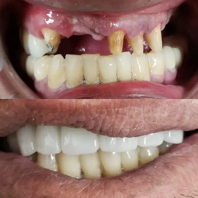Before and after image of dental implants