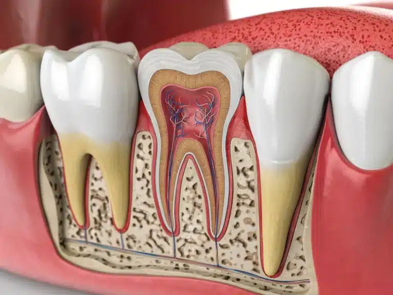 What Exactly Is a Root Canal?