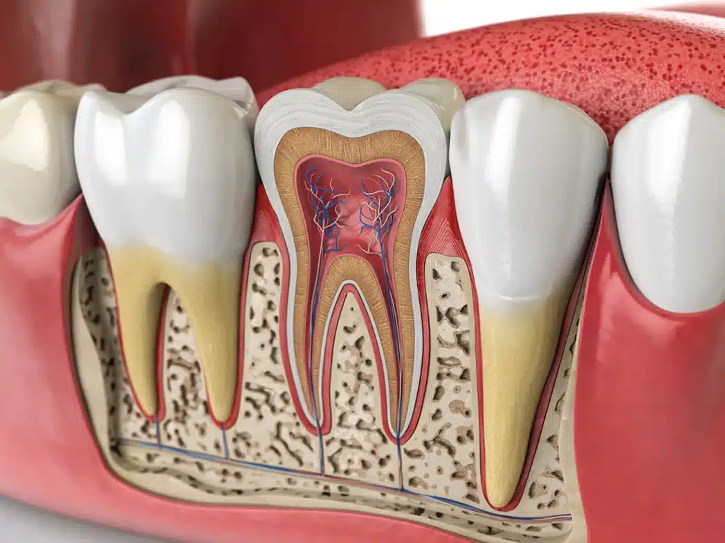 graphics of an inflamed tooth requiring a Root canal