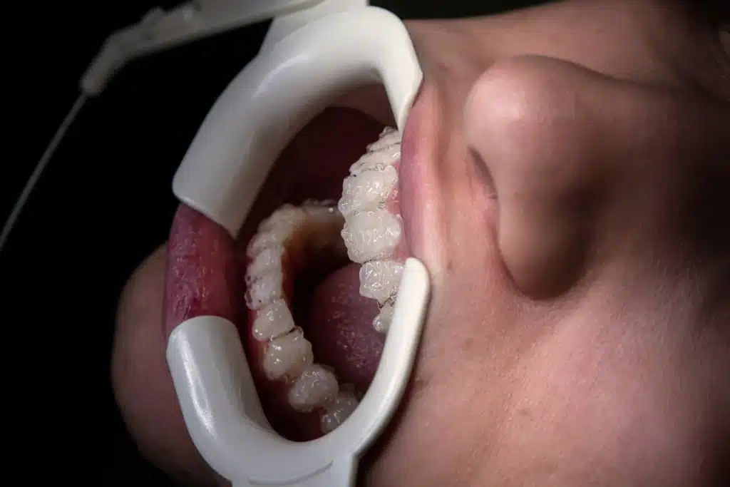 Root Canal Therapy using a tool to keep the patients mouth open