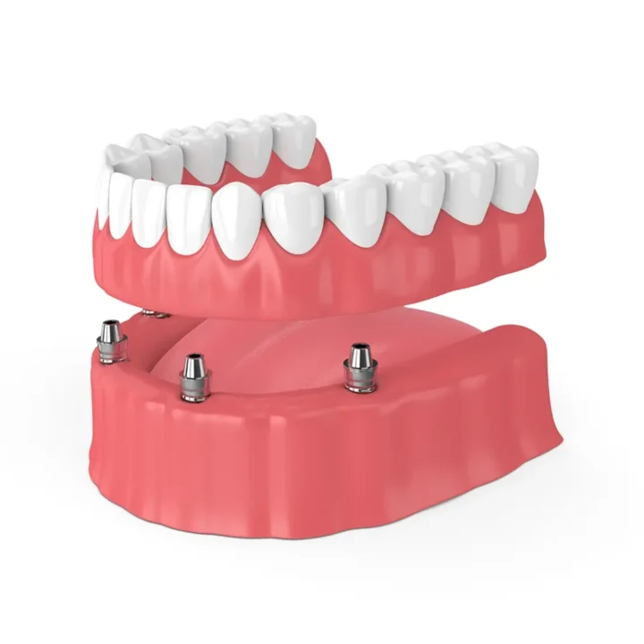 service-implant-retained-dentures Service implant retained dentures